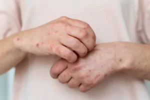 chickenpox scars in children