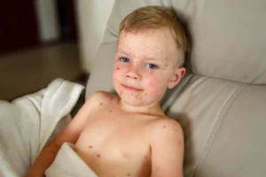 measles isolation precautions in children