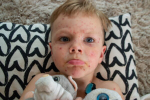 monkeypox in children