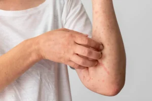 chickenpox scars removal